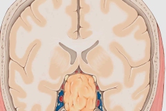 tumor-adenoma-de-hipofise-tratamentos-2