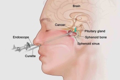 tumor-adenoma-de-hipofise-tratamentos-3
