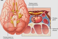 tumor-adenoma-de-hipofise-tratamentos-4