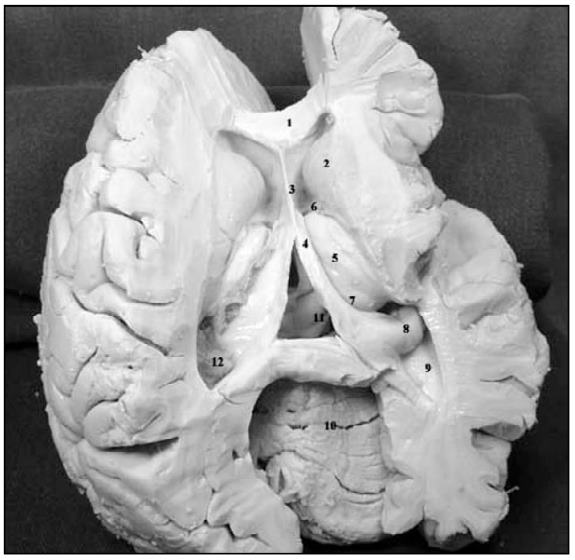 Estudo microanatômico da fissura coroideia na abordagem dos ventrículos e cisternas cerebrais