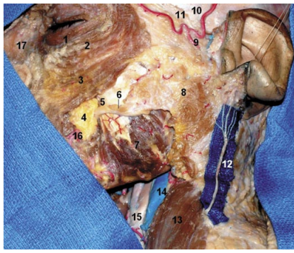 Fossa Infratemporal: microanatomia e abordagens cirúrgicas