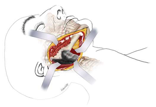 Aspectos anatômicos e nota técnica de uma abordagem retrofaríngea modificada e reconstrução do occipitocervical anterior junção