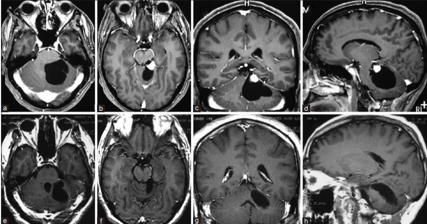 Hemangioblastoma de fossa posterior – Relato de 16 casos