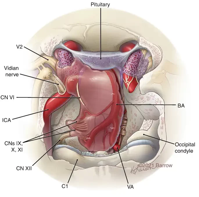 Meningiomas Petroclivais