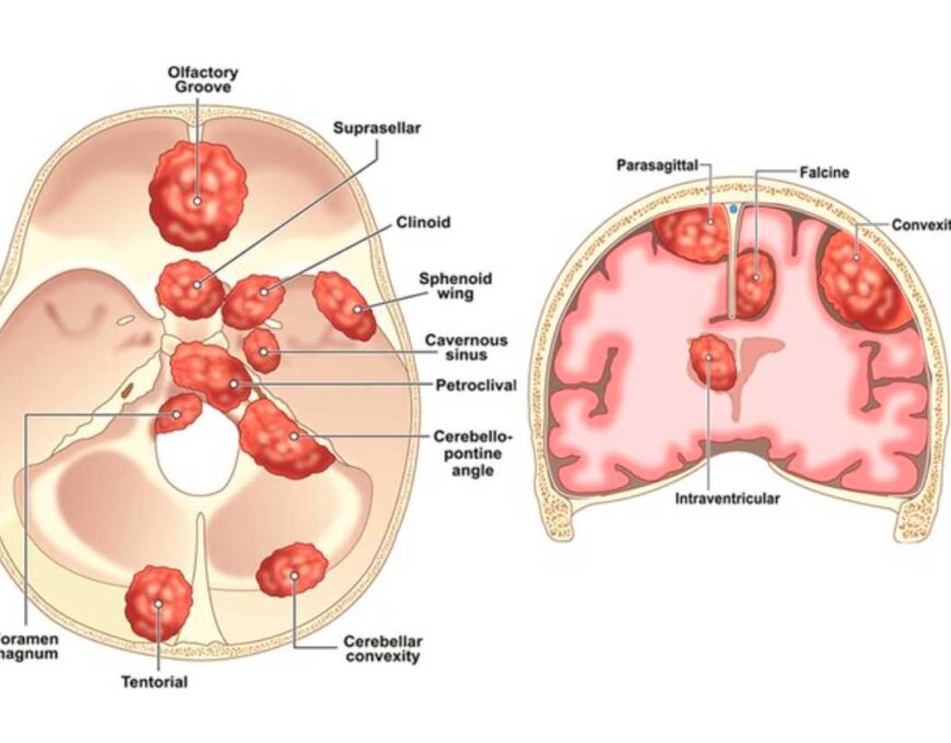 Meningiomas Clivais